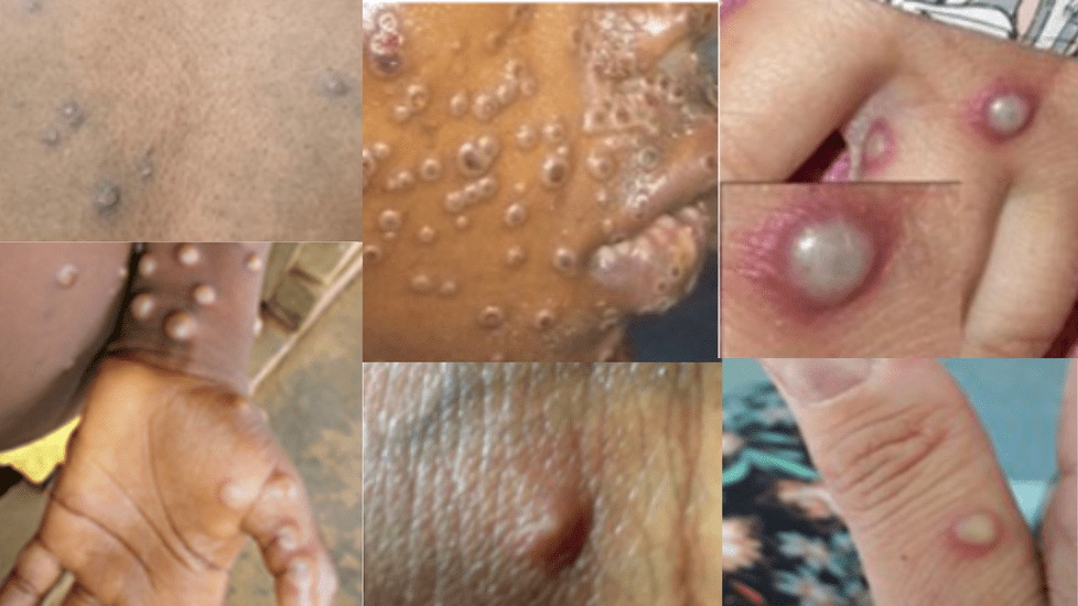 Monkeypox Outbreak: A Closer Look at the Symptoms and Prevention