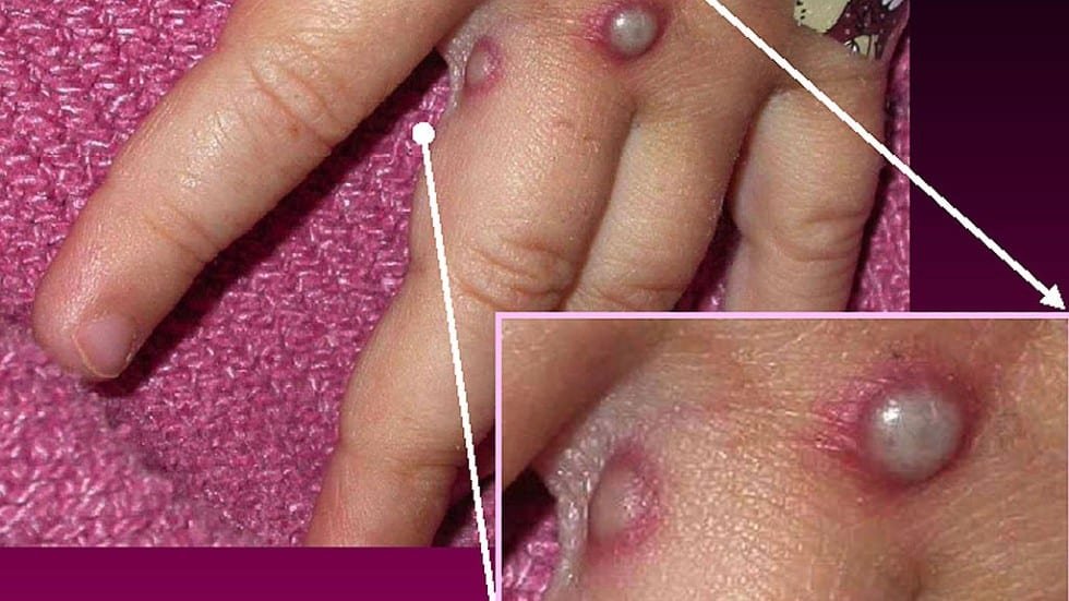 Monkeypox Outbreak: A Closer Look at the Symptoms and Prevention