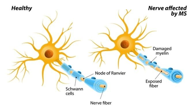 Multiple Sclerosis and Its Impact on Cognitive Function