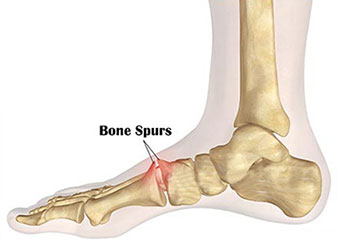 Natural Remedy For Bone Spurs