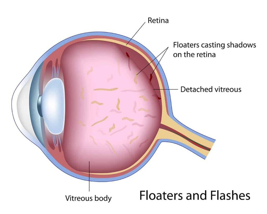 Natural Remedy For Eye Floaters-Eye Flashes