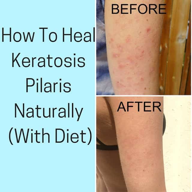 Natural Remedy For Keratosis Pilaris