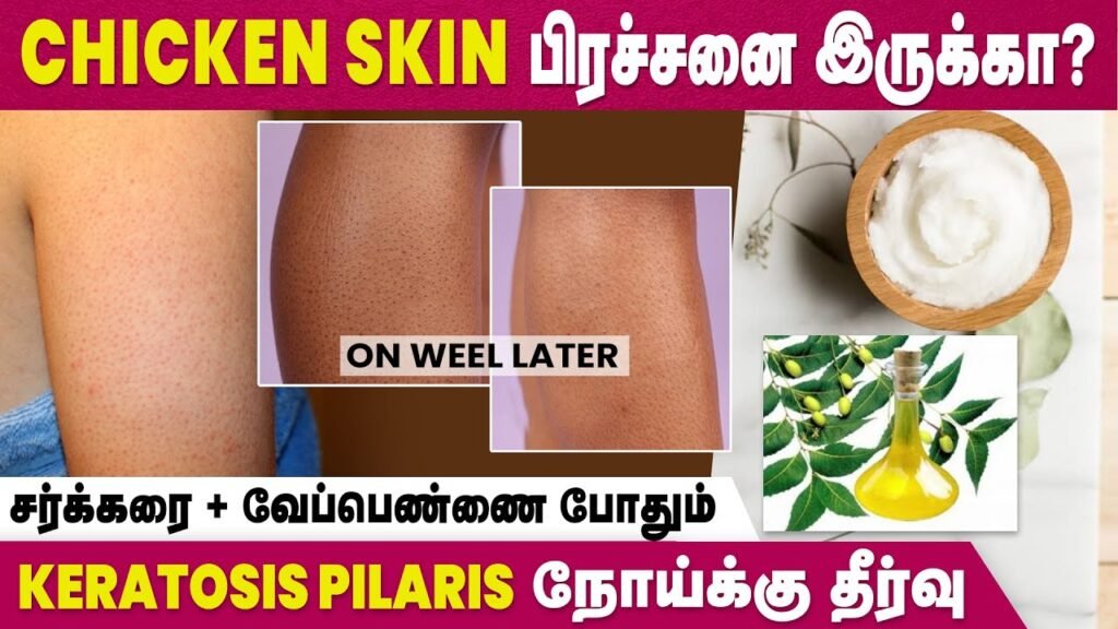 Natural Remedy For Keratosis Pilaris