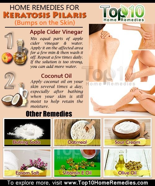 Natural Remedy For Keratosis Pilaris