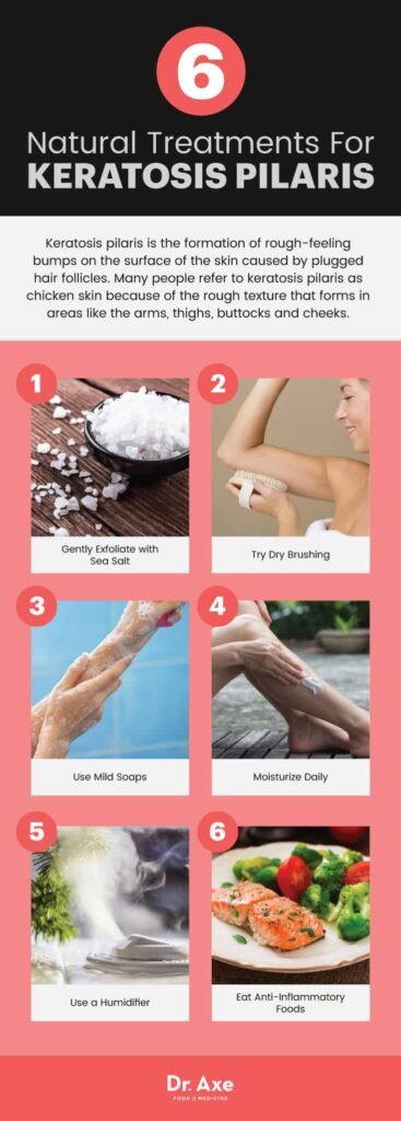Natural Remedy For Keratosis Pilaris