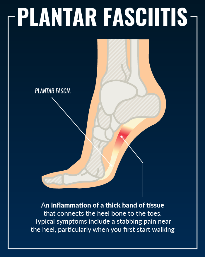Natural Remedy For Plantar Fasciitis