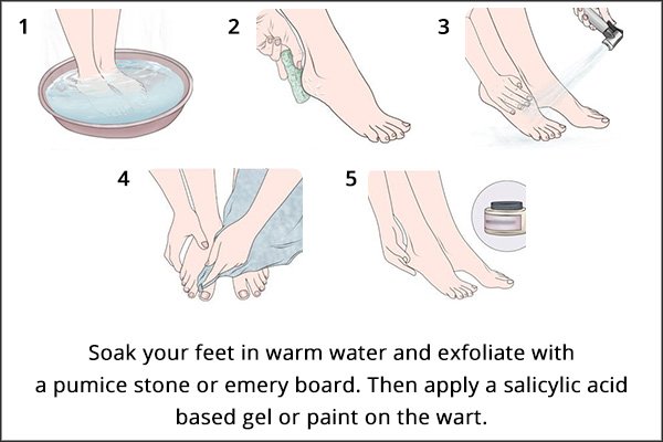 Natural Remedy For Plantar Warts