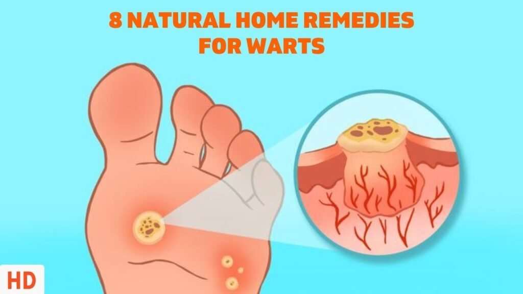 Natural Remedy For Plantar Warts