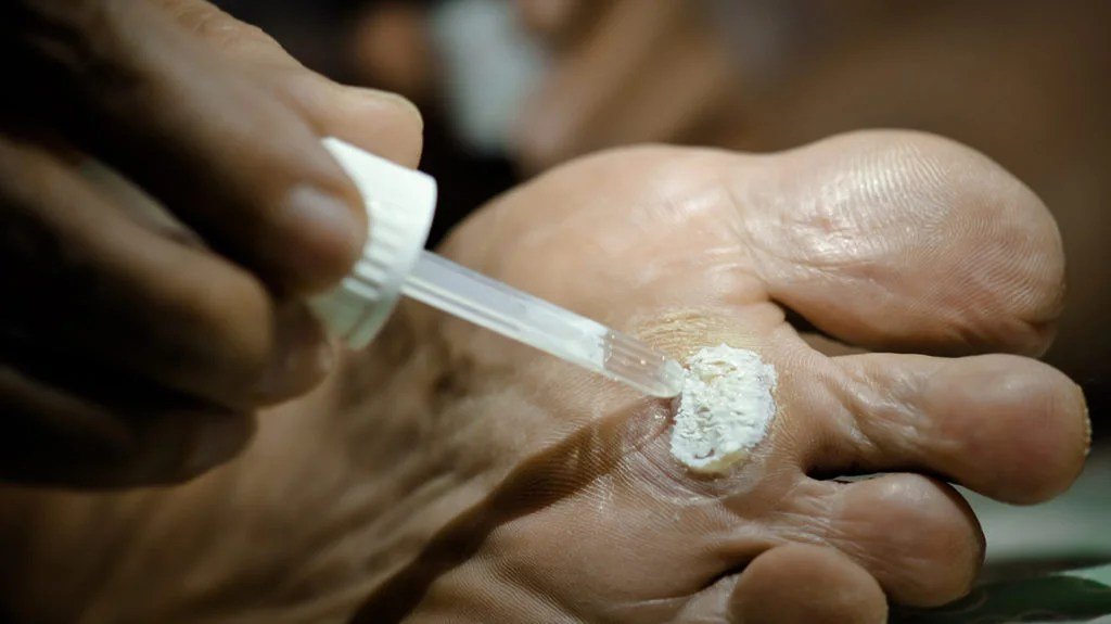 Natural Remedy For Plantar Warts