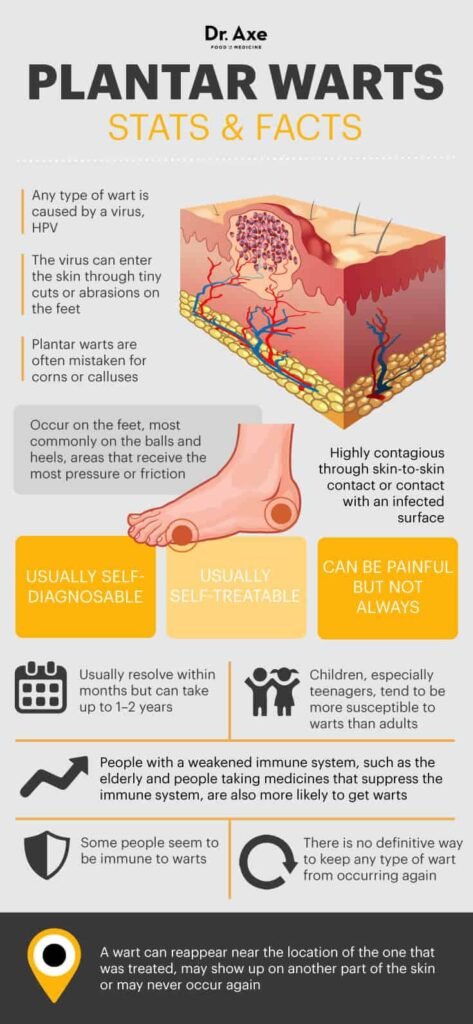 Natural Remedy For Plantar Warts