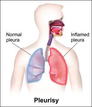 Natural Remedy For Pleurisy