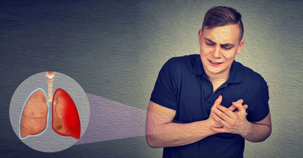 Natural Remedy For Pleurisy