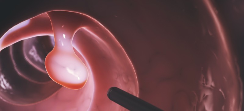 Natural Remedy For Polyps-Colon