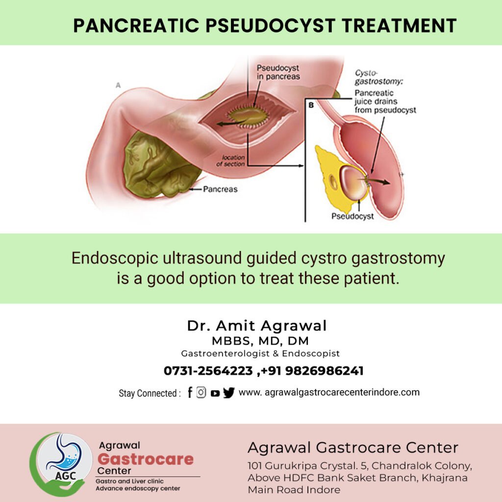 Natural Remedy For Pseudocyst