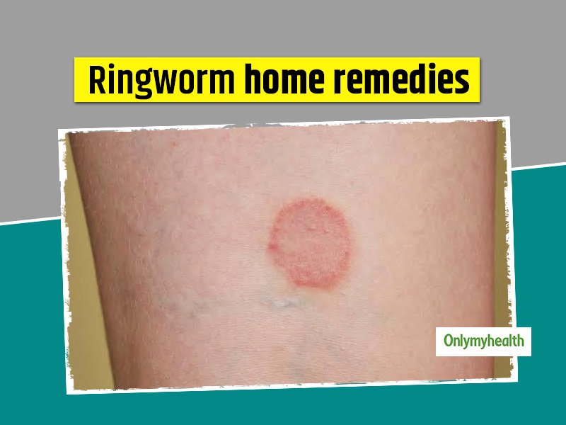 Natural Remedy For Ringworm