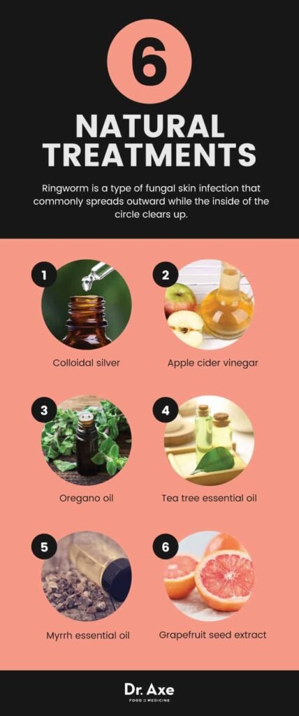 Natural Remedy For Ringworm
