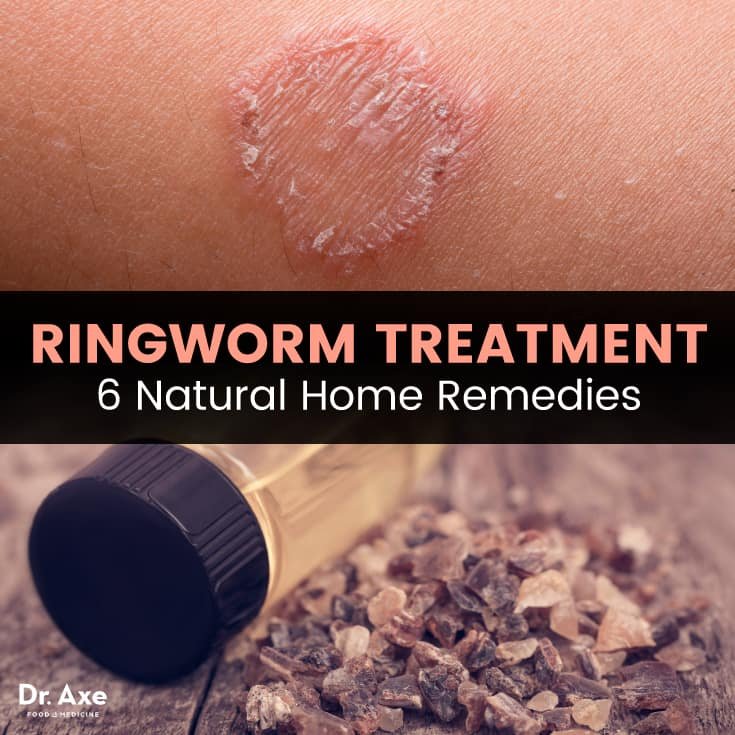 Natural Remedy For Ringworm
