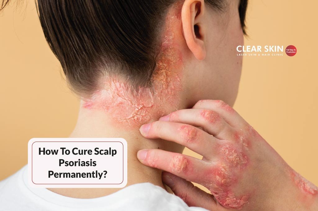 Natural Remedy For Scalp Psoriasis