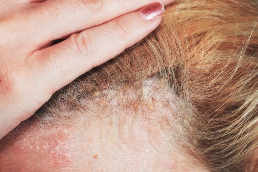 Natural Remedy For Scalp Psoriasis