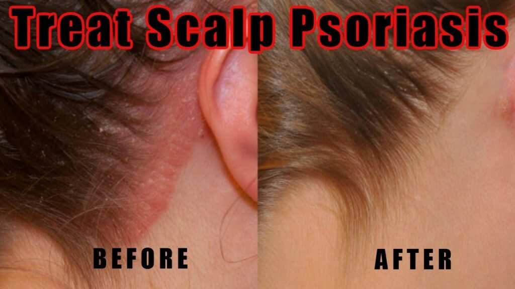 Natural Remedy For Scalp Psoriasis