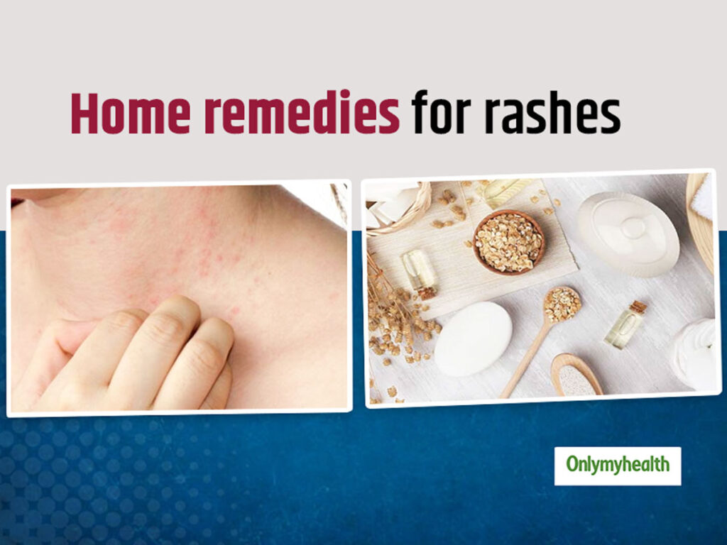 Natural Remedy For Skin Rash Ask The Nurse Expert