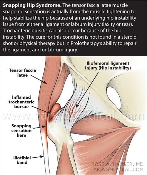Natural Remedy For Snapping Hip Syndrome Natural Remedy For Snapping Hip Syndrome