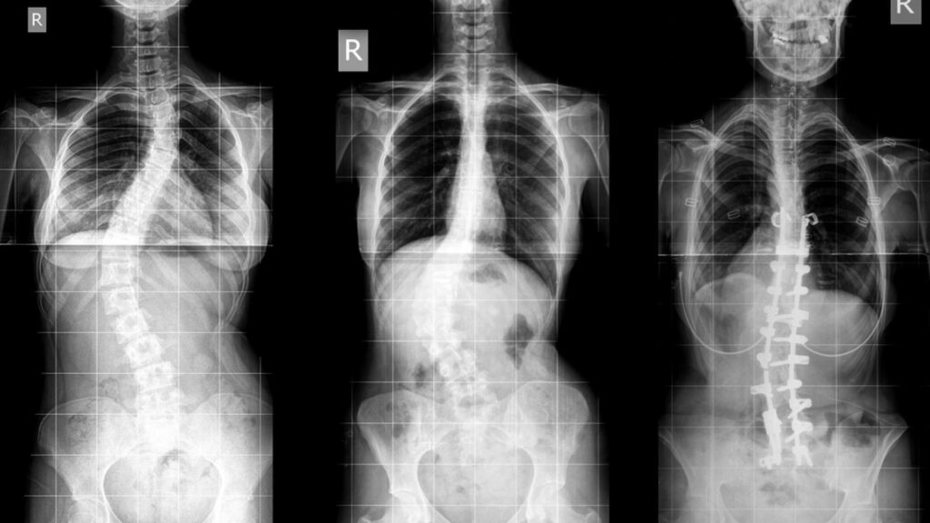 Natural Remedy For Spine Curvature Disorders