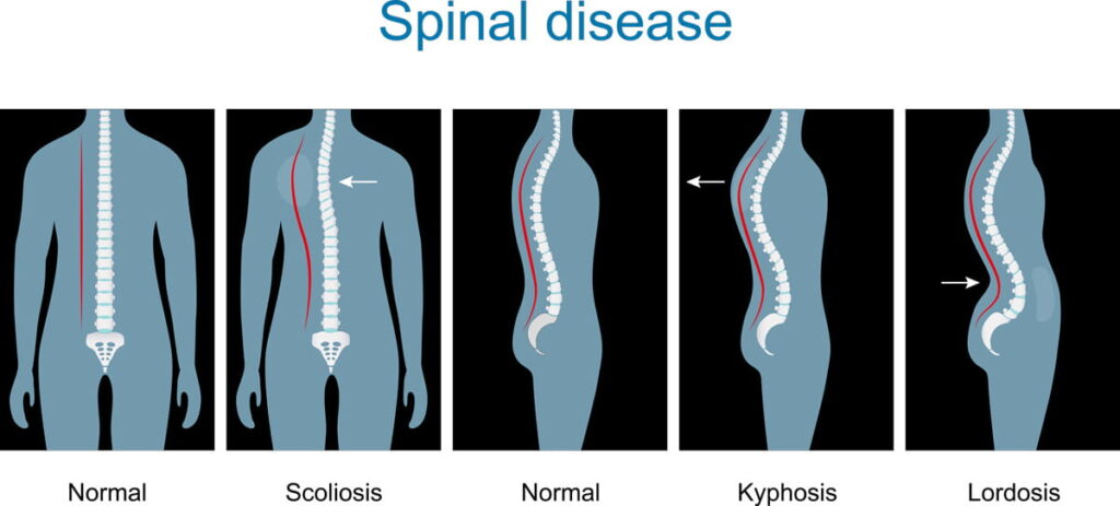 Natural Remedy For Spine Curvature Disorders