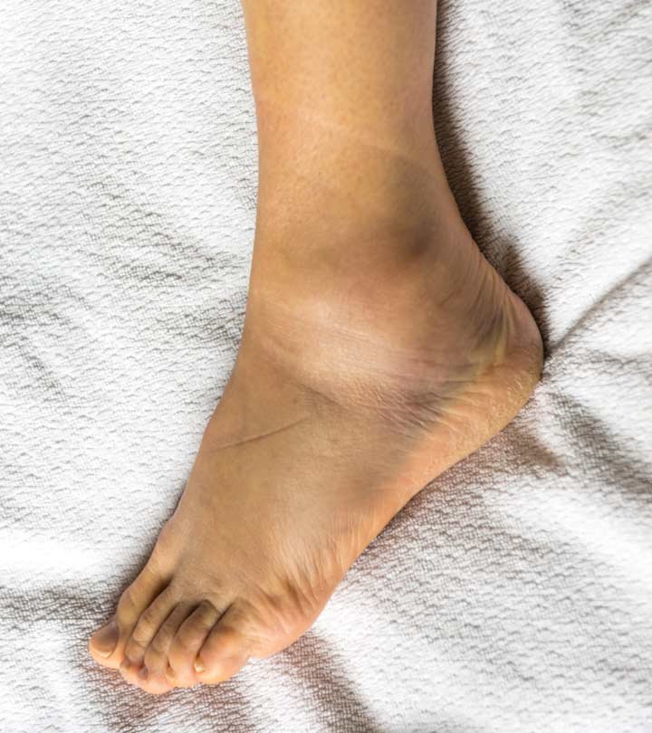 Natural Remedy For Swollen Feet Or Ankles