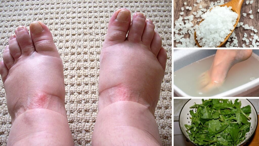 Natural Remedy For Swollen Feet Or Ankles