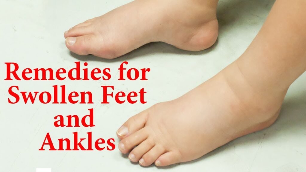 Natural Remedy For Swollen Feet Or Ankles