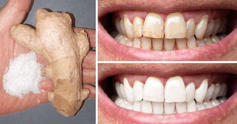 Natural Remedy For Teeth Whitening