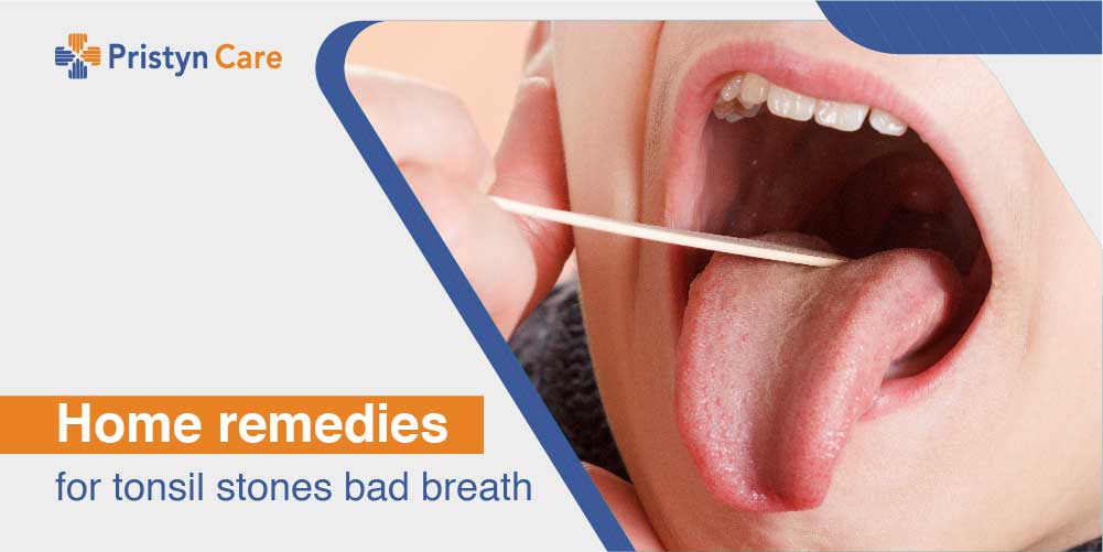 Natural Remedy For Tonsil Stones