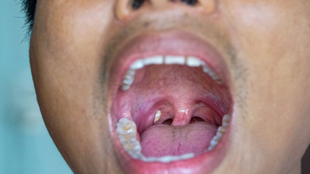 Natural Remedy For Tonsil Stones