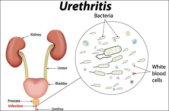 Natural Remedy For Urethritis