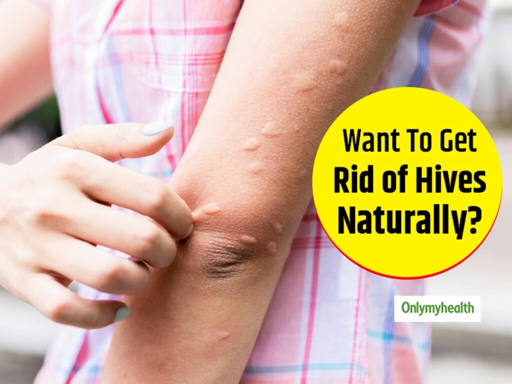 Natural Remedy For Urticaria Natural Remedy For Urticaria