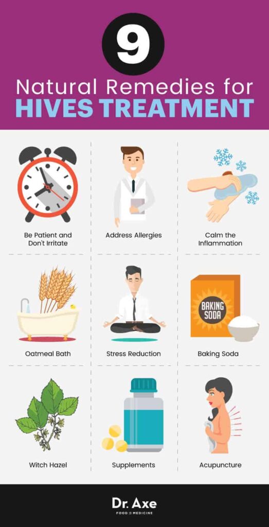 Natural Remedy For Urticaria Natural Remedy For Urticaria