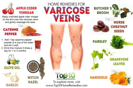 Natural Remedy For Varicose Veins Natural Remedy For Varicose Veins