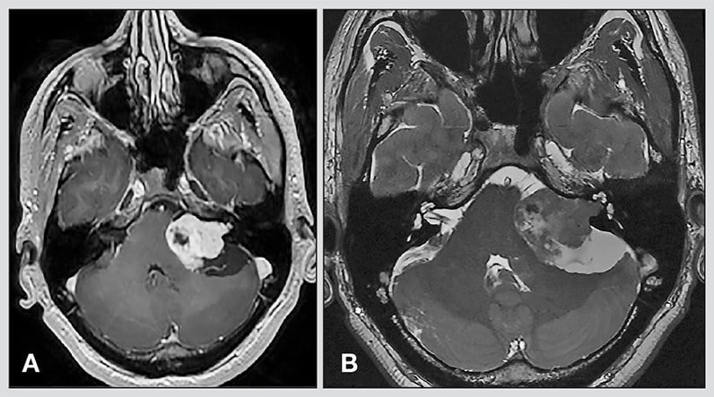 Navigating Life After Acoustic Neuroma Surgery