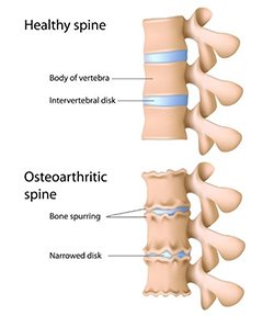 Nursing Considerations for Bone Spurs