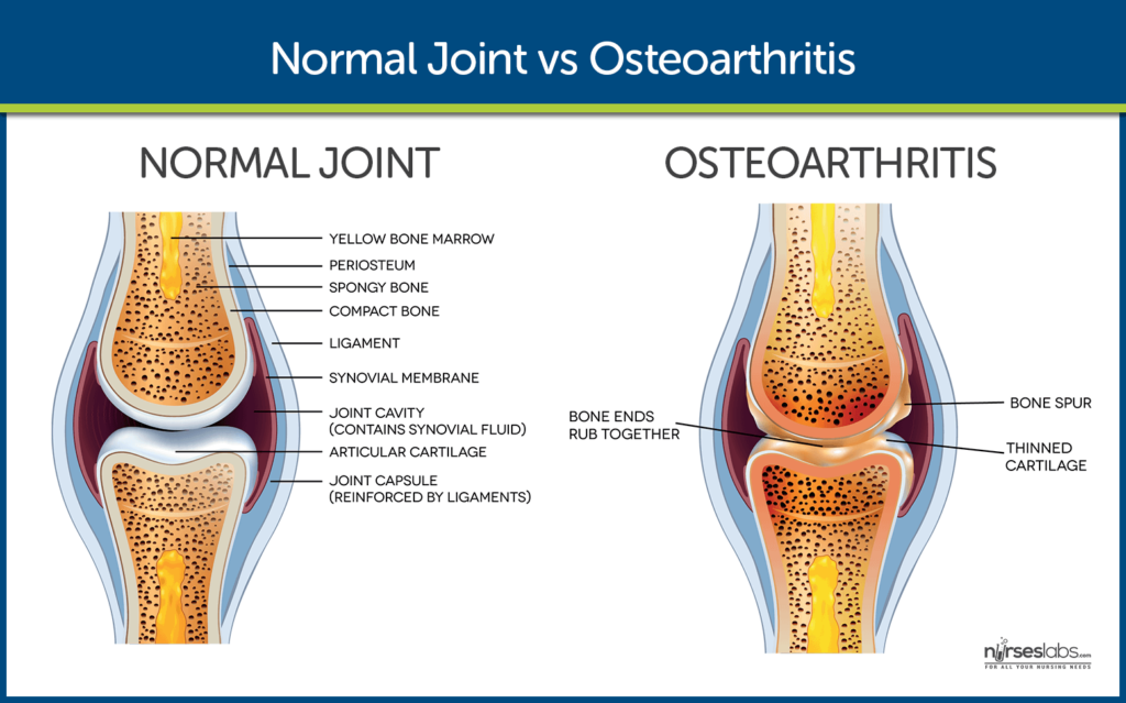 Nursing Considerations for Bone Spurs