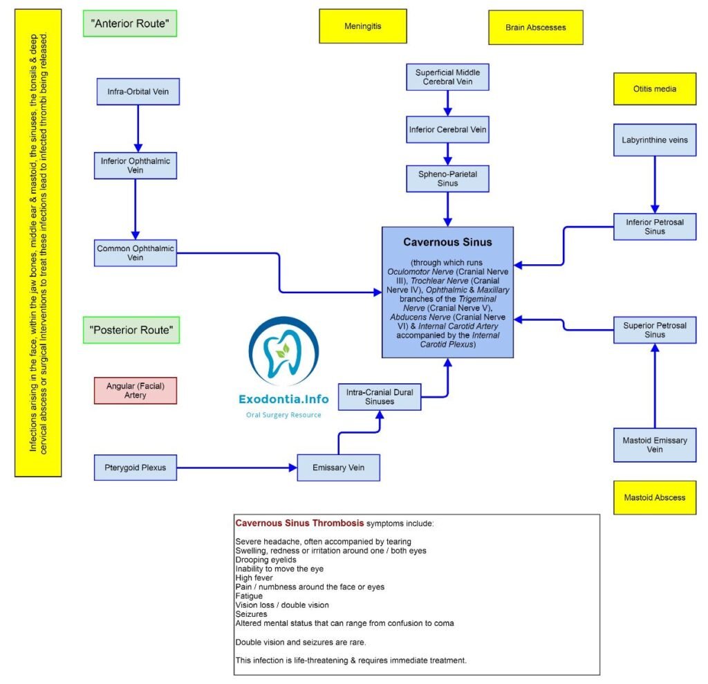 Nursing Considerations for Cavernous Sinus Thrombosis