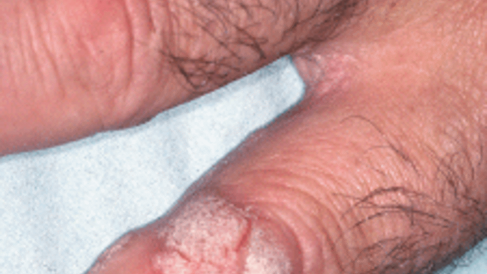 Nursing Considerations for Genital Warts-HPV