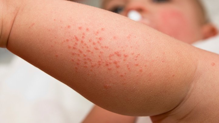 Nursing Considerations for Heat Rash
