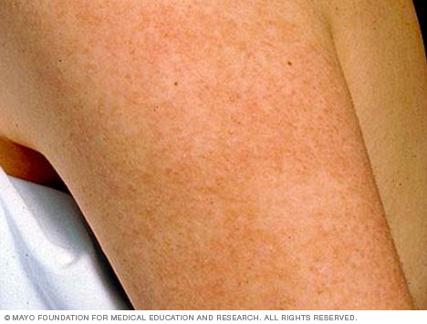 Nursing Considerations for Keratosis Pilaris