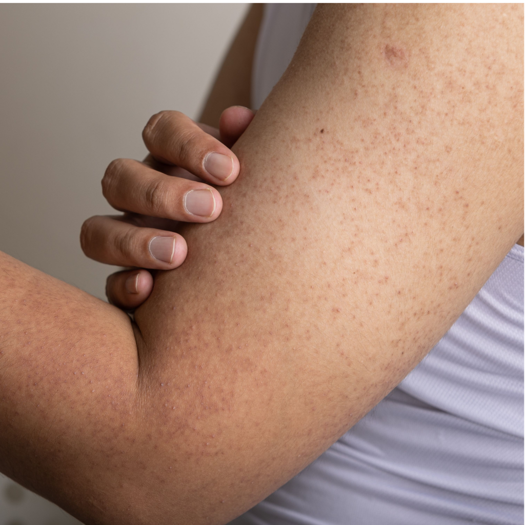 Nursing Considerations For Keratosis Pilaris Ask The Nurse Expert