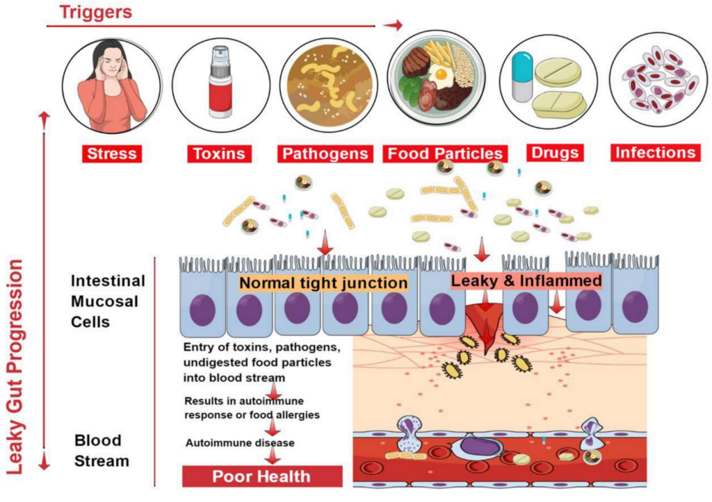 Nursing Considerations for Leaky Gut Syndrome