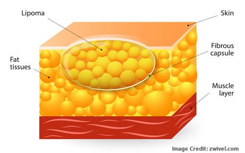 Nursing Considerations for Lipoma