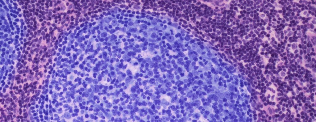 Nursing Considerations for Mad Cow Disease