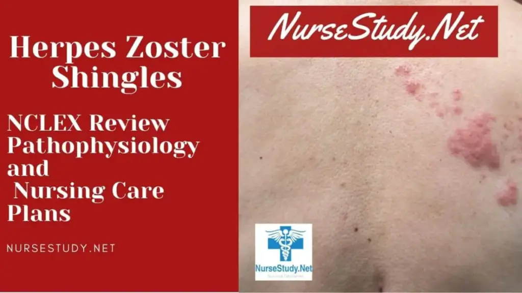 Nursing Considerations for Managing Zoster-Herpes Virus